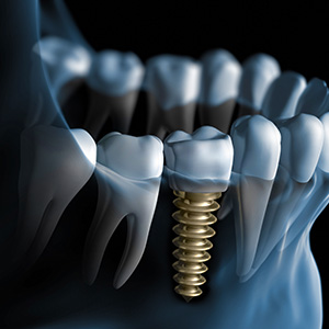 Alt A detailed 3D rendering showing a dental implant screwed into a tooth socket with surrounding teeth and gums, emphasizing the precision of dental implantation procedures.